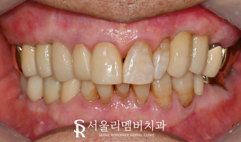 사당역 치과 충치, 치아 흔들림, 파절, 결손, 염증.. 다수의 복합 문제 생겼다면 임플란트 신경치료 크라운 과정 관련 이미지 6