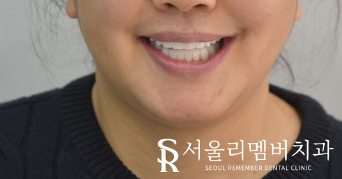 금방이라도 빠져버릴 것 같은 치아들, 전체임플란트 식립으로 개선했던 이야기. 이수역 서울 리멤버 치과 관련 이미지 7