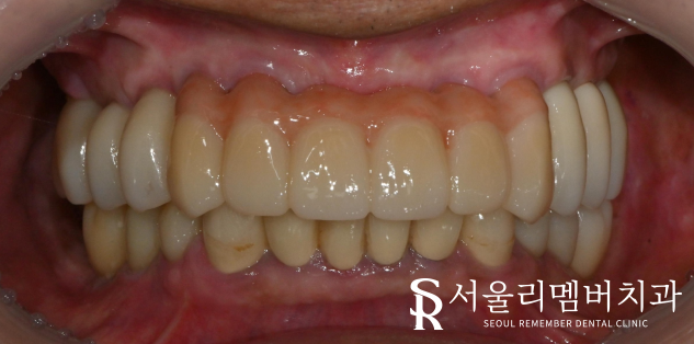 서울대입구역치과 수면마취를 사용한 전체 임플란트 식립 과정 관련 이미지 6