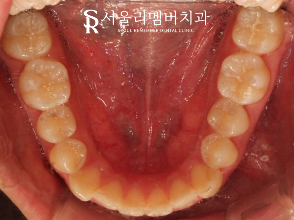 서울대입구역 치과 툭 튀어나온 돌출 때문에 발치교정 진행 관련 이미지 3