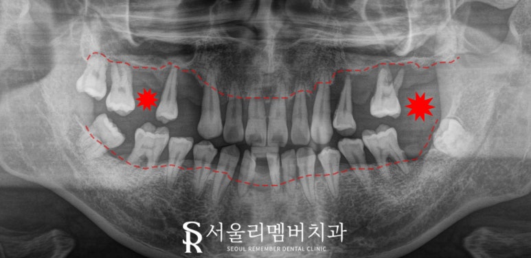 치아 빠지고 흔들리는 어금니와 치주 질환으로 통증 생긴 구강, 관악구 치과 상악 전체 임플란트 및 하악 신경치료 크라운 진행 과정 관련 이미지 1