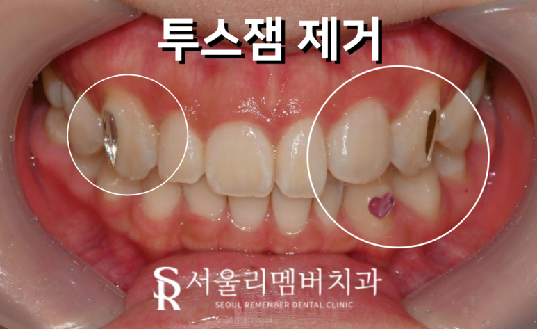 MZ 세대 인기 만점 투스잼(Tooth Gem), 어떻게 붙이고 어떻게 제거할까요? 서울대입구치과 관련 이미지 2