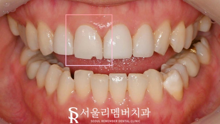 서울대입구역 치과, 깨진 앞니 라미네이트 한 개만 교체 치료 가능할까요? 관련 이미지 1