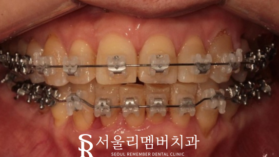 40대 교정 지금 시작해도 늦지 않을까요? 서울대입구역 치과 관련 이미지 7