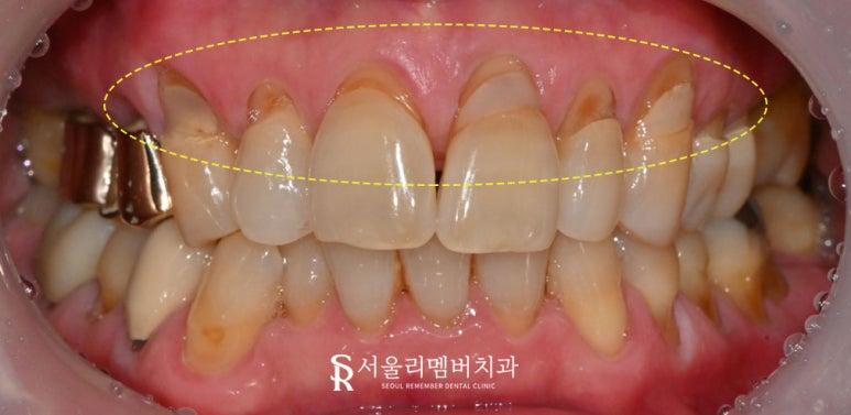 찌릿한 잇몸 패임, 서울대입구역치과 에서 티 안 나게 한 번에! 관련 이미지 1