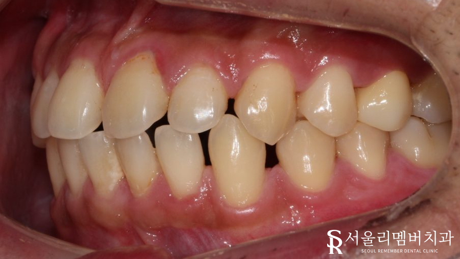 벌어진 치아, 사당 치과 인비절라인으로 개선할 수 있을까? 관련 이미지 4