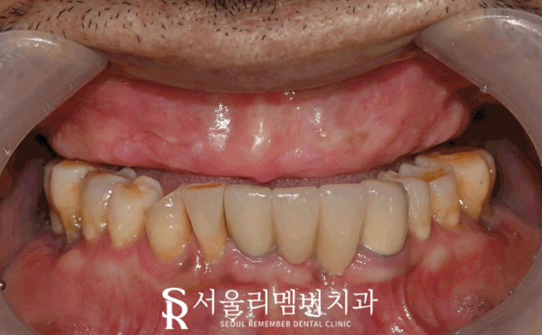 서울대입구역 치과 치아가 하나도 없는 무치악 환자를 위한 최소 비용 풀아치 임플란트 관련 이미지 8