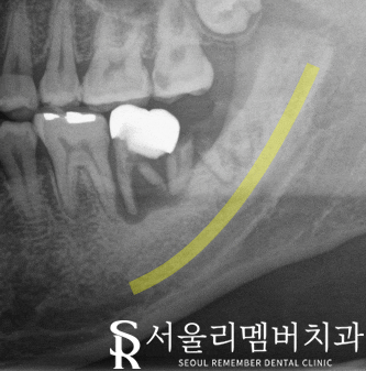 사당역 치과 신경치료와 임플란트로 건강한 치아 되찾기 관련 이미지 2
