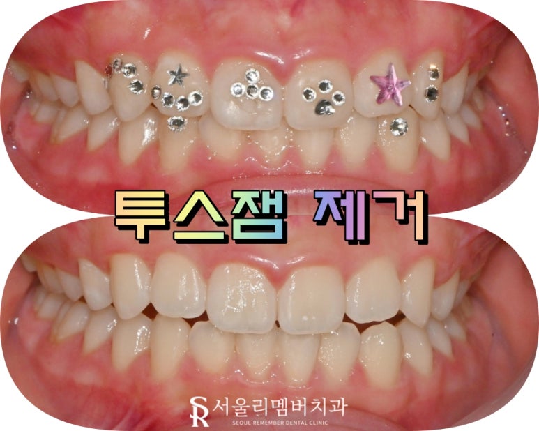 서울대입구역 치과 투스잼 제거 꼭 전문가에게 해야 되는 이유와 관리 방법 관련 이미지 4