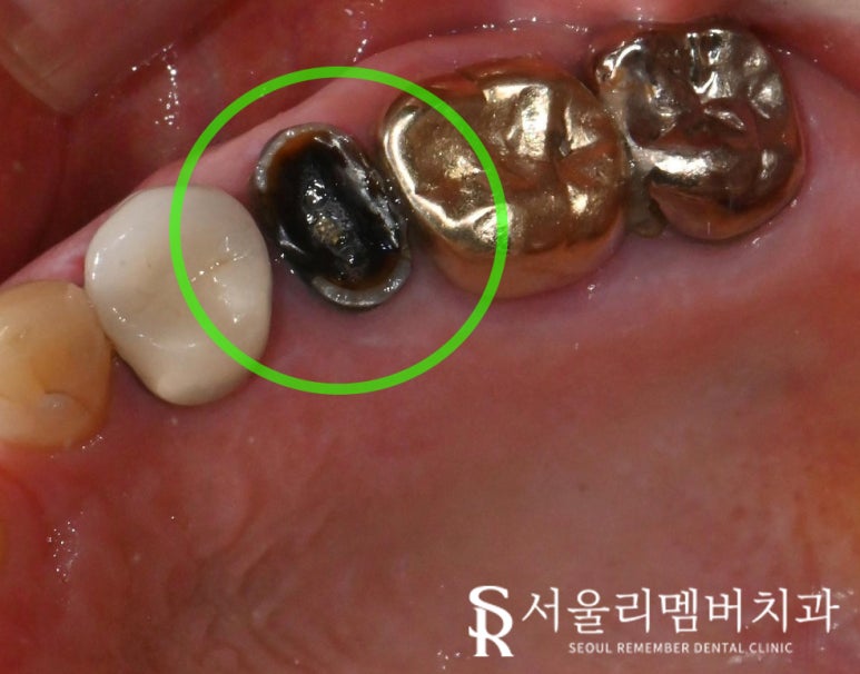 치아 곳곳에서 생긴 문제, 사당 치과 임플란트 및 크라운 치료 관련 이미지 3
