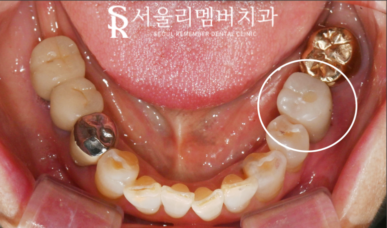 신림역 치과 오스템 BA 임플란트 당일 수술로 빠져버린 어금니 회복 관련 이미지 5