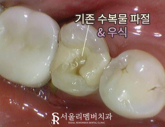 치아 깨지고 통증 있을 때, 서울대입구역 치과 파절 정도에 따른 신경치료 크라운 및 발치 임플란트 관련 이미지 2