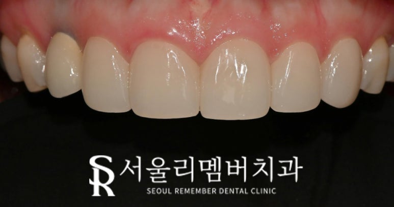 상도동 치과 "진짜(real, 리얼) 같은 자연스러움" 개인 맞춤형 무삭제 라미네이트 관련 이미지 3