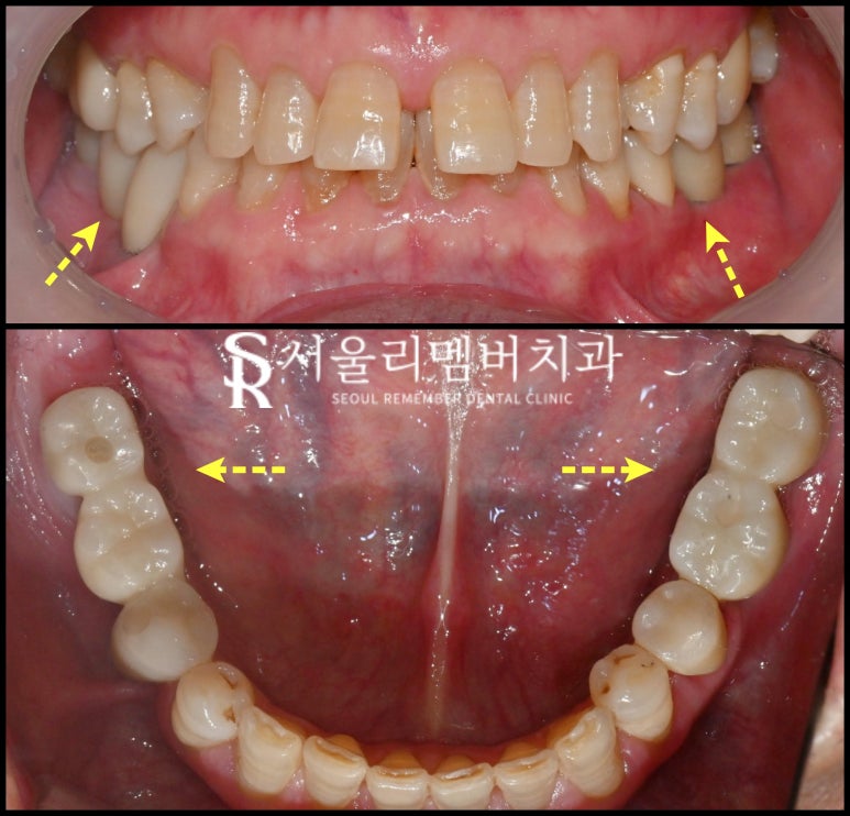"오래된 크라운 있는 쪽으로 아파서 밥을 못 먹어요." 보라매 치과 임플란트 및 신경치료 후기 관련 이미지 3