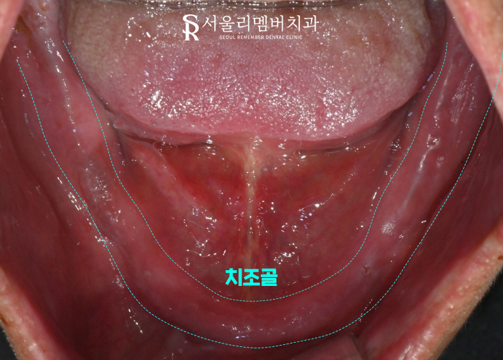 서울대입구역 양심 치과, 최소 비용으로 전체 임플란트 수술 관련 이미지 4