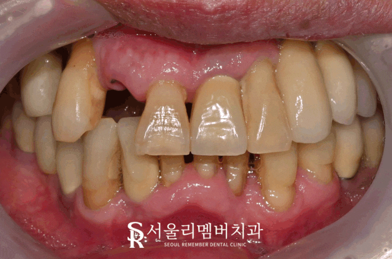 앞니 깨짐 및 충치, 임플란트 크라운 탈락 시 빠른 치료가 중요한 이유 서울대입구역 치과 관련 이미지 1