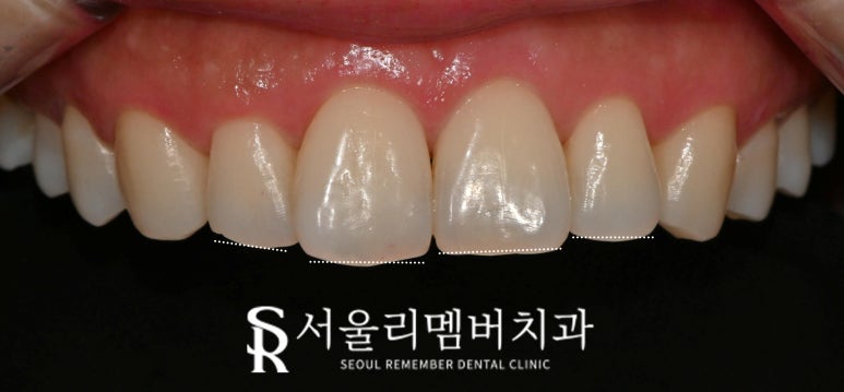 낙성대 치과 앞니 틀어짐 하악 전치 측절치 결손 라미네이트로 공간 닫기 성공 관련 이미지 2