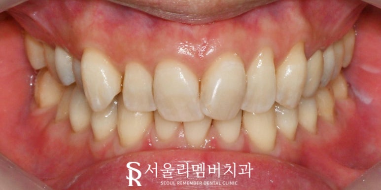 신림역 치과 스케일링 치석제거로 착색과 변색 해결하면 치아미백 만큼 하애질 수 있을까? 관련 이미지 4