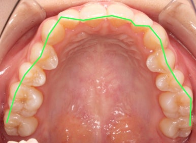 조기접촉 교정 전 관련 이미지 4