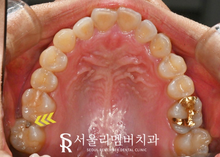 봉천동 치과 인레이 했던 치아가 깨졌다면? 스트라우만 나이스 인레이 재치료 관련 이미지 2