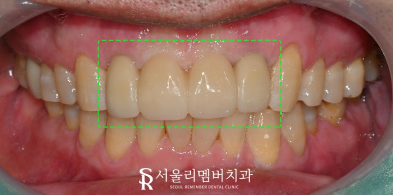 서울대입구역 치과 오래된 브릿지 부러진 앞니 발치 후 네비게이션 임플란트 식립 사례 관련 이미지 4
