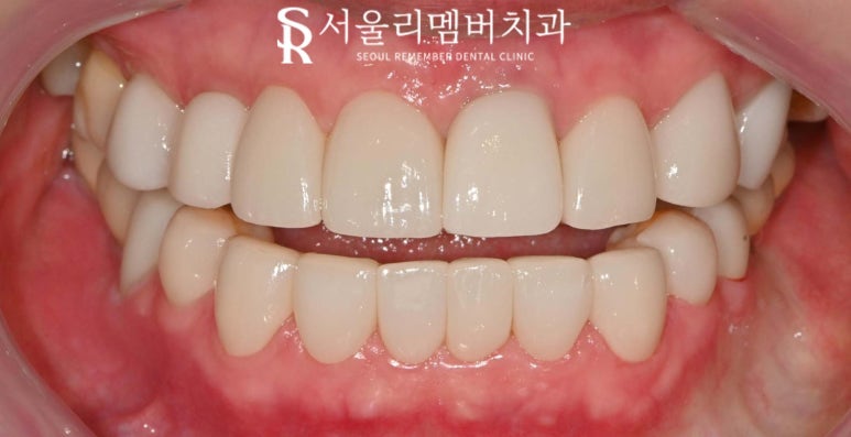 중년 치열 틀어짐 및 파절과 변색, 봉천동 치과 치아교정 대신 심미보철 치료 (임플란트 크라운 라미네이트 복합 증례) 관련 이미지 5