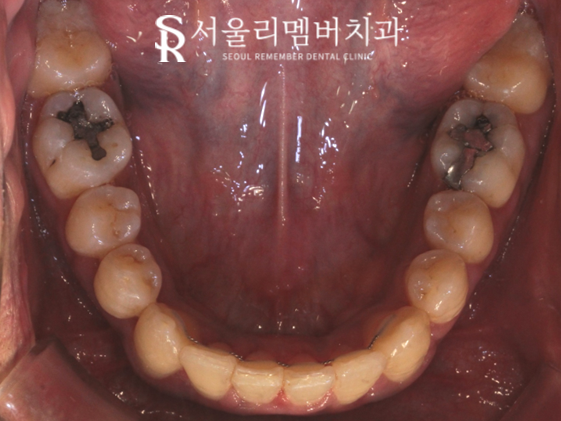 서울대입구역 치과 에서 들쑥날쑥 했던 치열, 비발치로 개선해 드렸습니다. 관련 이미지 9