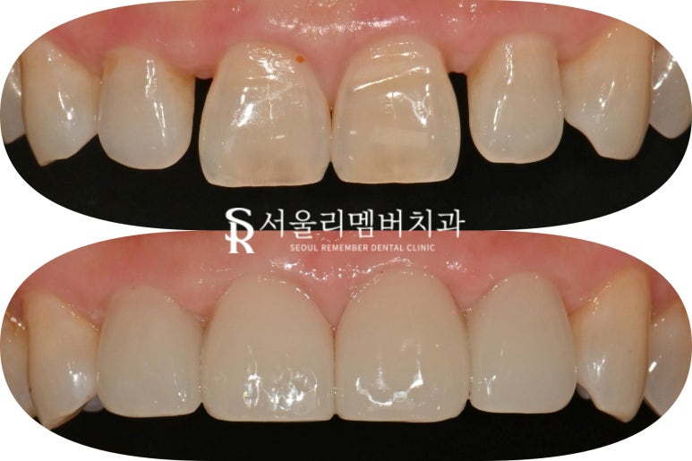 Restore a Natural, Even Smile with No-Prep Realnate! Laminate Veneers for Front Teeth at a Seoul National University Entrance Station Dental Clinic image 7
