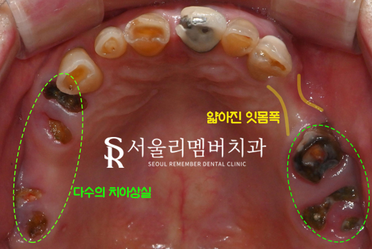 서울대입구역 치과 에서 수면(의식하진정)요법 동반한 전체 임플란트 식립 관련 이미지 4