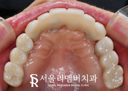 서울대입구역 치과 에서 수면(의식하진정)요법 동반한 전체 임플란트 식립 관련 이미지 7