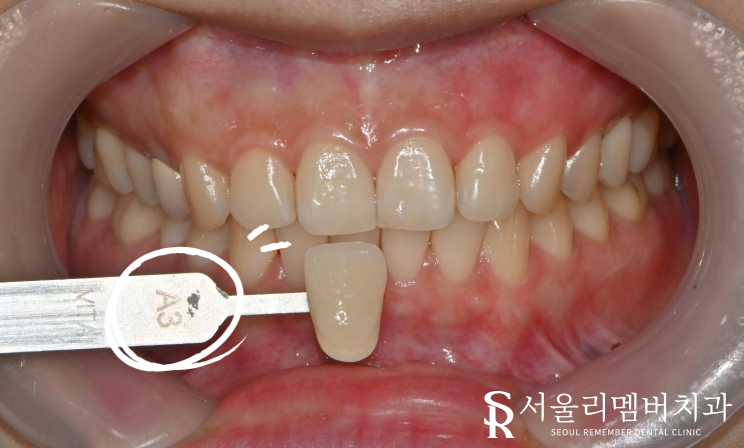 "앞니가 변색돼서 보기 싫어요" 보라매 치과 에서 미백치료 관련 이미지 1