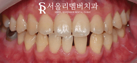 은천동 치과 치아 사이 벌어짐, 당일 치료 가능할까요? 관련 이미지 1