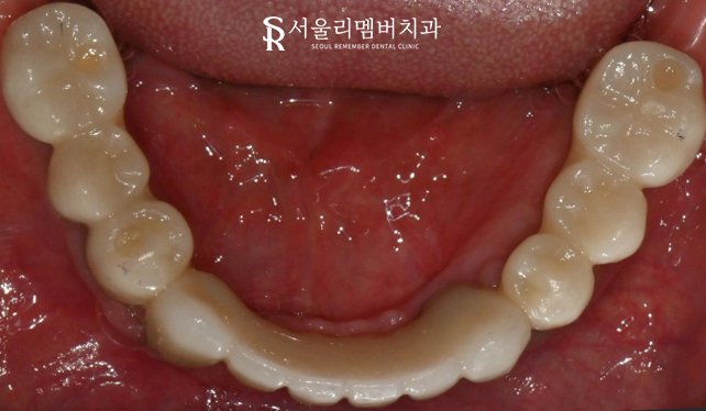 신대방 치과 고난도 전악 임플란트 수술 가능 관련 이미지 9