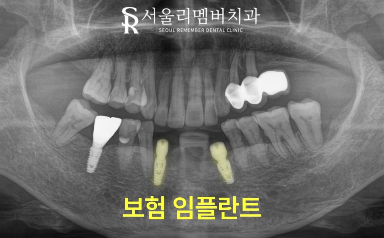 Loose Lower Front Teeth, Sillim Station Dental Clinic, Insurance Anssurge Implant for Patients 65 and Older, Minimal Placement, Lower Cost, Faster Completion image 6