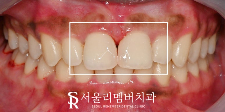 신림 치과 벌어진 앞니 정중이개 다이아스태마 레진 당일 충전 치료 관련 이미지 2