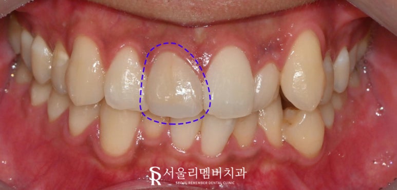 서울대입구역 치과 치아 뿌리 끝 근단 농양 염증 및 인접면 우식 있던 앞니 신경치료 후 크라운으로 자연스럽게 심미성 회복 관련 이미지 1
