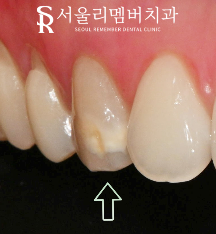 치아의 하얀 반점(화이트 스팟 white spot) 서울대입구역 치과 아이콘 레진으로 무삭제 반점치 충치 치료 관련 이미지 1