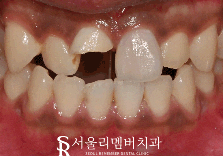 심하게 부러진 앞니의 해결 방안은? 상도동 치과 신경치료 과정 통해 알 수 있습니다. 관련 이미지 3