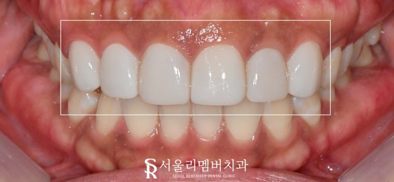 Maxillary Six-Anterior Veneers with RealNate for a Chipped Front Tooth with a Sharp, Rough Edge image 3