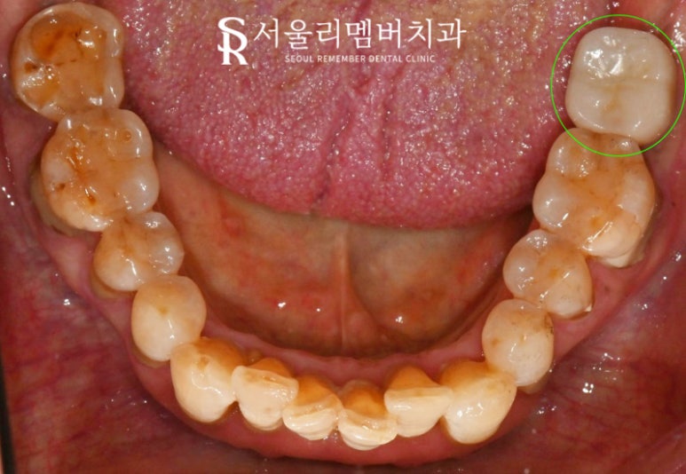 잃어버린 치아, 봉천동 치과 임플란트로 되찾는 자연스러운 미소와 건강한 저작 기능 관련 이미지 4