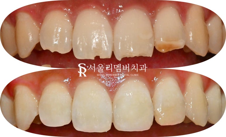 봉천동 치과 위 앞니 상악 4전치 파절 레진 당일 치료 과정, 비용, 견적, 시간 관련 이미지 3
