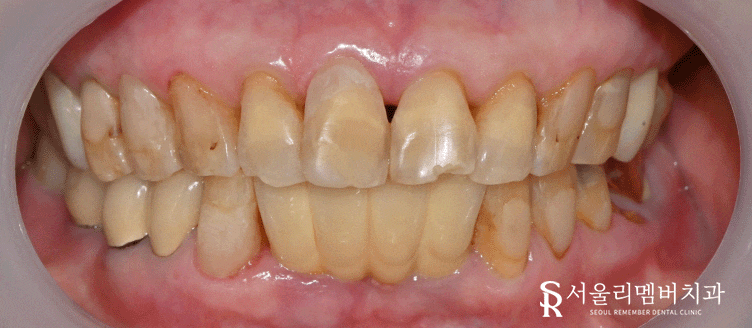 잇몸이 패여서 이가 시려요 서울대입구역 치과 레진 수복 증례 관련 이미지 3