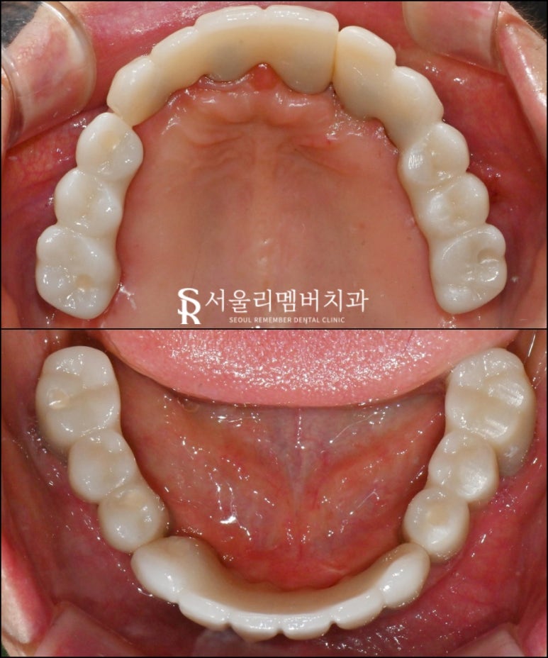 치주염으로 균형이 깨져버린 구강, 신대방 치과 에서 전체 임플란트 수술 증례 관련 이미지 4