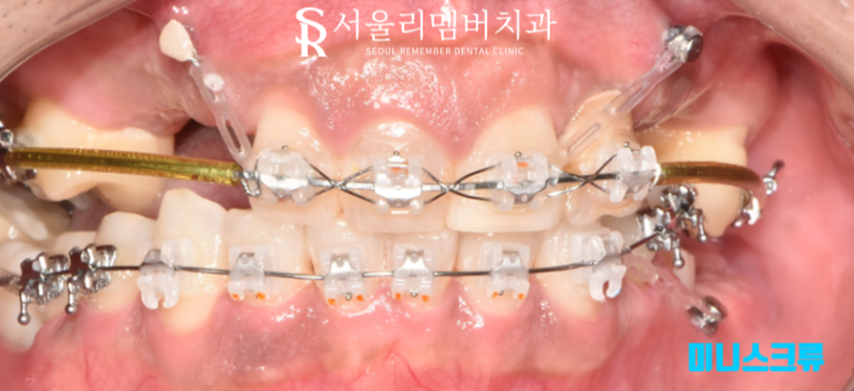 임플란트와 치아교정, 동시에 치료받을 수 있을까요? 남성역 서울 리멤버 치과 관련 이미지 5