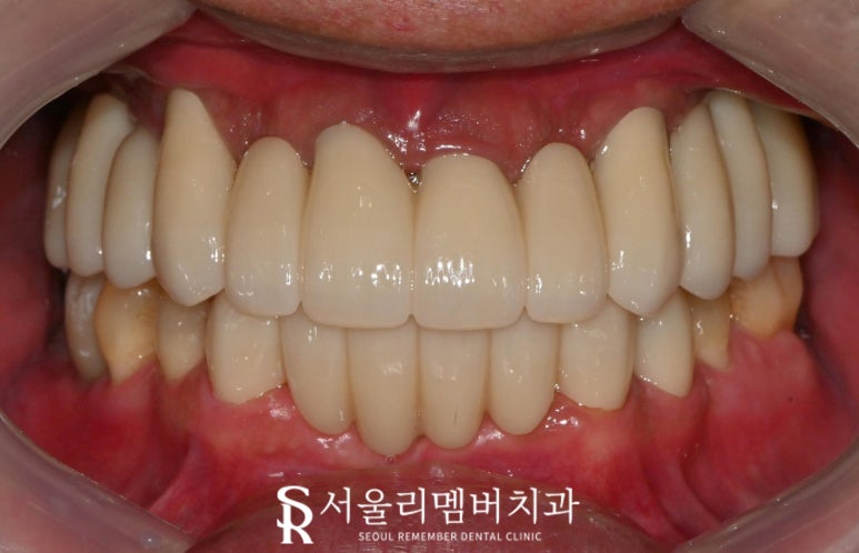 치아 빠지고 흔들리는 어금니와 치주 질환으로 통증 생긴 구강, 관악구 치과 상악 전체 임플란트 및 하악 신경치료 크라운 진행 과정 관련 이미지 6