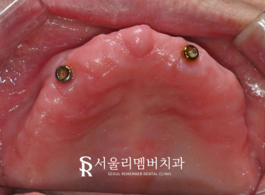 올바른 교합의 중요성, 서울대입구역치과 전체 임플란트 기간 및 과정 관련 이미지 2