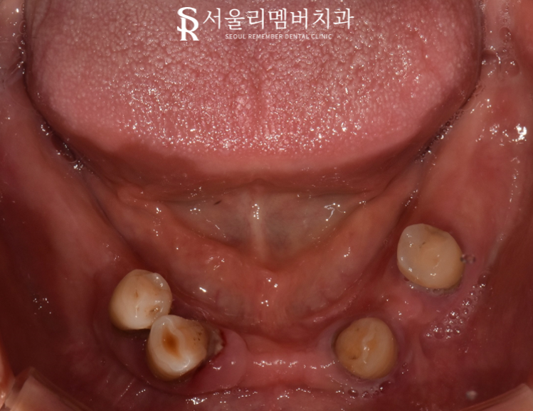 오랜 틀니 착용으로 잇몸이 다 망가졌던 분.. 임플란트 식립으로 밝은 미소 되찾아드렸습니다! 서울대입구역 서울 리멤버 치과 관련 이미지 3
