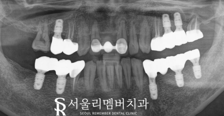 한 번에 많은 치아 치료해야 된다면? 사당역 치과 수면 임플란트 로 편안하게 관련 이미지 6