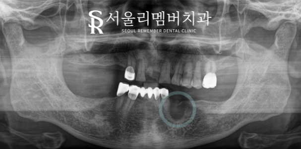 저작 기능을 살려주는 어금니 임플란트 식립 과정 서울대입구치과 관련 이미지 1