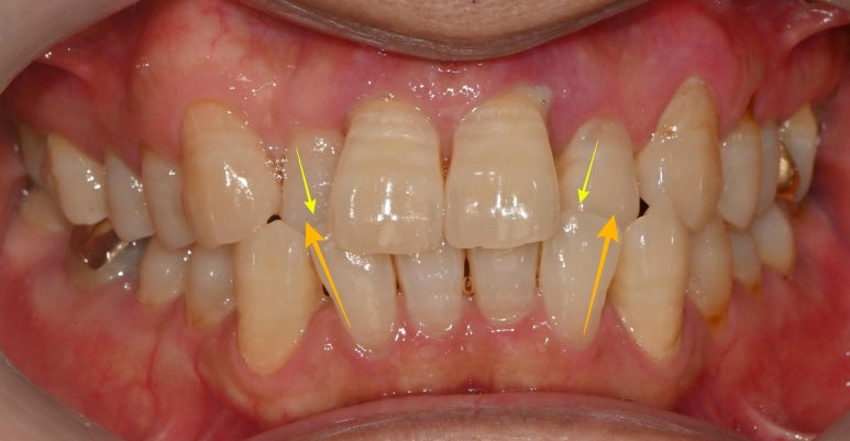 보라매 치과 삐뚤어진 교합 불량 앞니, 임플란트로 가지런하게 만들어드린 사례 관련 이미지 2